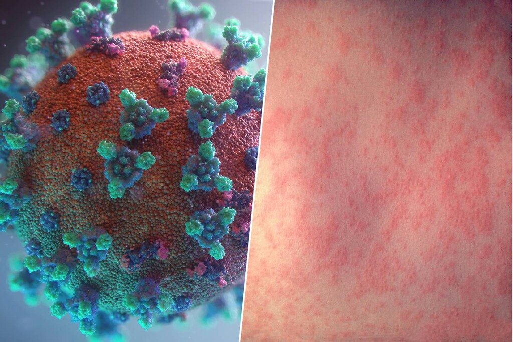 Confirman 21 casos de sarampión en Tabasco; sector salud refuerza llamado a vacunación